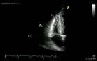 Amyloidosis Of The Heart And Hypertrophic Right Ventricular