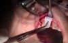 Debridement & Periosteal Release - Extraction #7 With Socket Grafting
