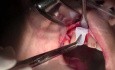 Debridement & Periosteal Release - Extraction #7 With Socket Grafting