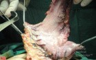 Gastric Ulcerated Adenocarcinoma of the Pre-pyloric Antrum (16 of 28)