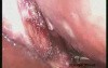 Deep Seated Gallbladder In Laparoscopic View