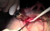 Flap Design & Pilot Holes - Implant Surgery, #5-6-7 Sites