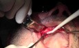 Flap Design & Pilot Holes - Implant Surgery, #5-6-7 Sites