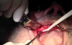Flap Design & Pilot Holes - Implant Surgery, #5-6-7 Sites