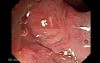 Giant Tubulo - Villous Adenoma (7 of 17)
