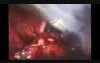 Laparoscopic Pelvic Lymphadenectomy