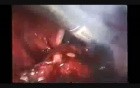 Laparoscopic Pelvic Lymphadenectomy