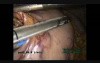 Laparoscopic/Thoracoscopic Esophagectomy