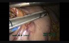 Laparoscopic/Thoracoscopic Esophagectomy