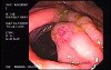 Zollinger- Ellison Syndrome - Gastric Ulcer with Gastrocolic Fistula (6 of 21)