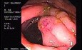 Zollinger- Ellison Syndrome - Gastric Ulcer with Gastrocolic Fistula (6 of 21)