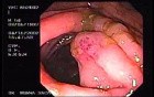 Zollinger- Ellison Syndrome - Gastric Ulcer with Gastrocolic Fistula (6 of 21)