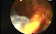 Hysteroscopic Aspect Of Trophoblastic Retention