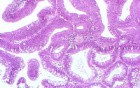 Sessile Tubulovillous Adenoma  (12 of 13)