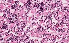Erythroid hyperplasia - Histopathology - Bone marrow