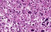 Neoplasia - MSP - 7d