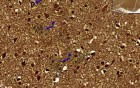 Alzheimer disease - Histopathology - Brain