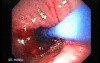 Esophagus - Pneumatic Dilation for Achalasia - Balloon Observed from the Stomach