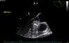 Treatment for Hypertrophic Obstructive Cardiomyopathy - Alcohol Septal Ablation