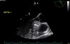Treatment for Hypertrophic Obstructive Cardiomyopathy - Alcohol Septal Ablation