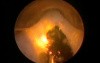 Greenlight HPS Prostatectomy
