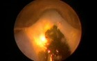 Greenlight HPS Prostatectomy