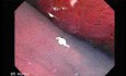 Colonoscopic Polypectomy (5 of 23)