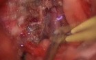 MCF Meningioma - Left Subtemporal-Pterional Approach
