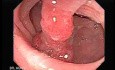 Endoscopic Appearance of Pedicled Polyp of the Descending Colon (1 of 7)