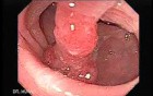 Endoscopic Appearance of Pedicled Polyp of the Descending Colon (1 of 7)