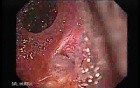 Ileal Neobladder Substitution (ileal bladder) (4 of 9)