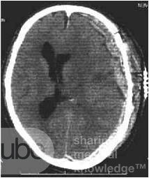 SubDural Hematom