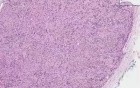 Schwannoma