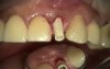 Immediate Implant And Provisional Upper Incisor