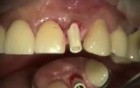Immediate Implant And Provisional Upper Incisor