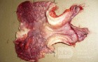 Endoscopy of Scirrhous Gastric Carcinoma involving the entire Fundus, Body and the Antrum (43 of 47)