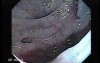 Sigmoid Diverticulitis - Colovesical Fistula (7 of 8)