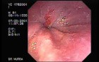 Barrett's Esophagus 