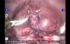 Robotic Nephrectomy