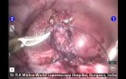 Robotic Nephrectomy