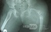 Proximal Focal Femoral Diffeciency