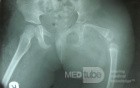Proximal Focal Femoral Diffeciency
