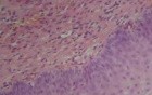 Cervical canal - Histopathological examination
