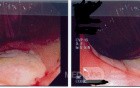 Cecal Ulcer due to NSAID's