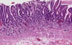 Stomach - Atrophic Gastritis