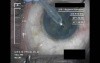 Cataract Surgery VI - Part 2