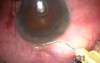 Microcornea With Glaucoma - Transciliary Filtration