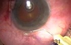 Microcornea With Glaucoma - Transciliary Filtration