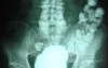 Sigmoid Diverticulitis - Colovesical Fistula (1 of 8)
