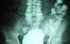 Sigmoid Diverticulitis - Colovesical Fistula (1 of 8)